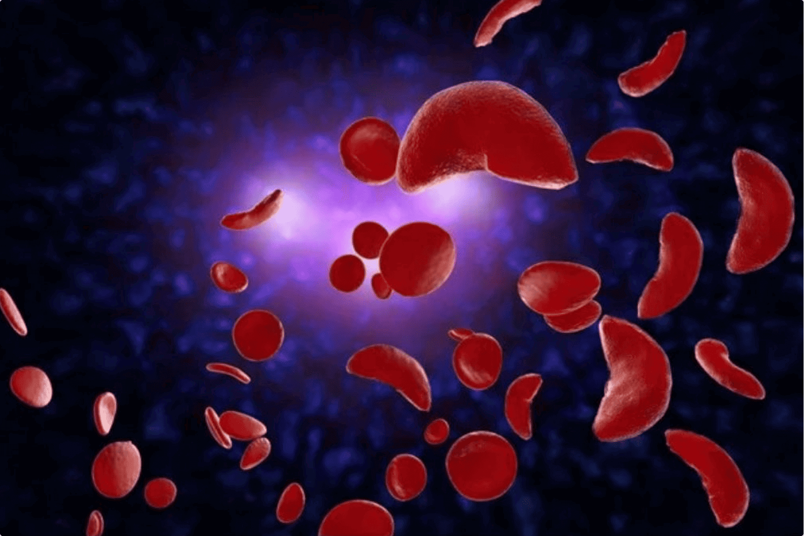 Managing Sickle Cell Disease and Thalassemia with Blood Transfusions