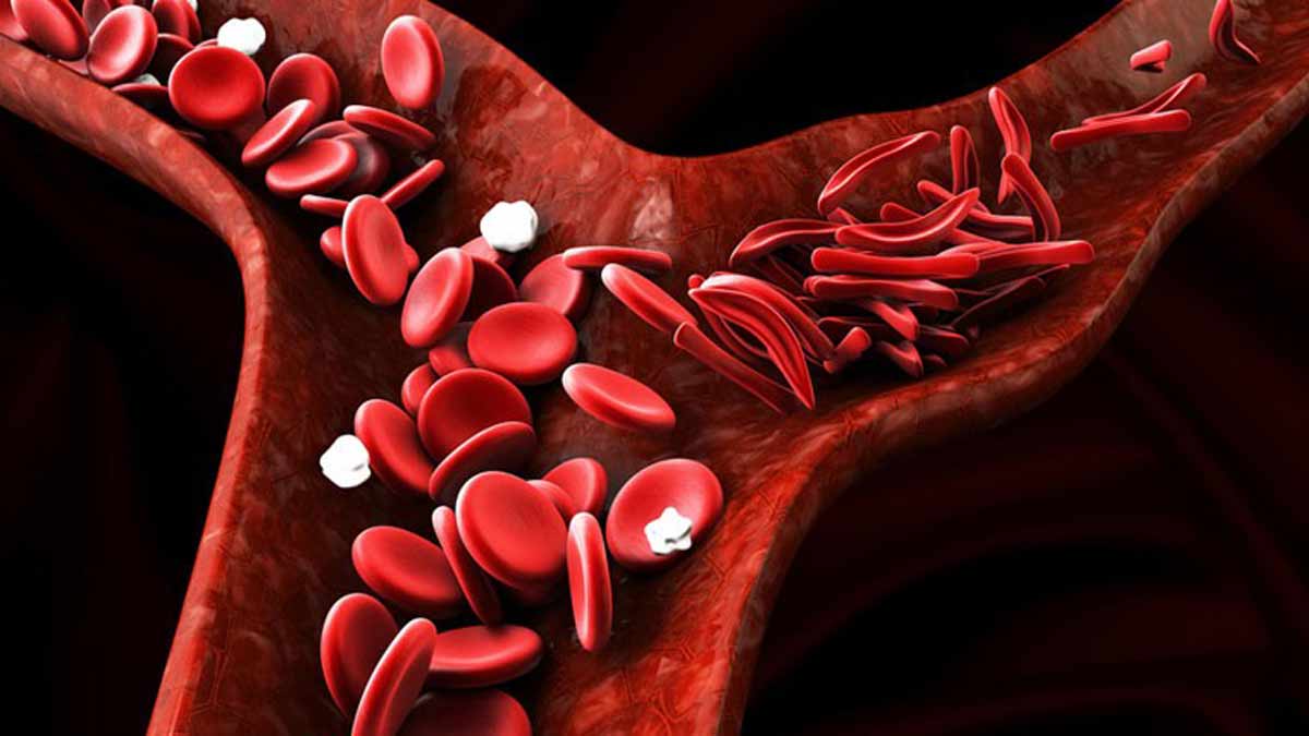 World Sickle Cell Day | What India needs to do to eliminate this genetic blood disorder by 2047